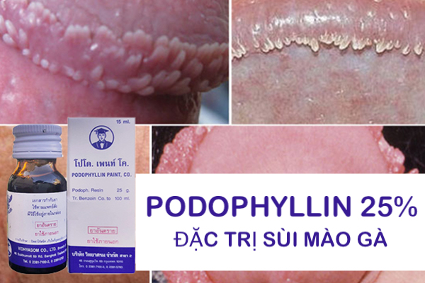 Thuốc Podophyllin 25 Thái Lan trị sùi mào gà nhanh an toàn nam nữ Thuốc Podophyllin 25 Thái Lan trị sùi mào gà nhanh an toàn nam nữ