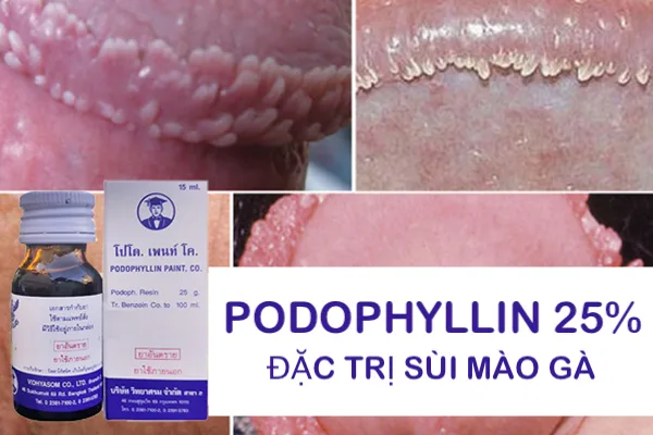 Thuốc Podophyllin 25 Thái Lan trị sùi mào gà hiệu quả an toàn